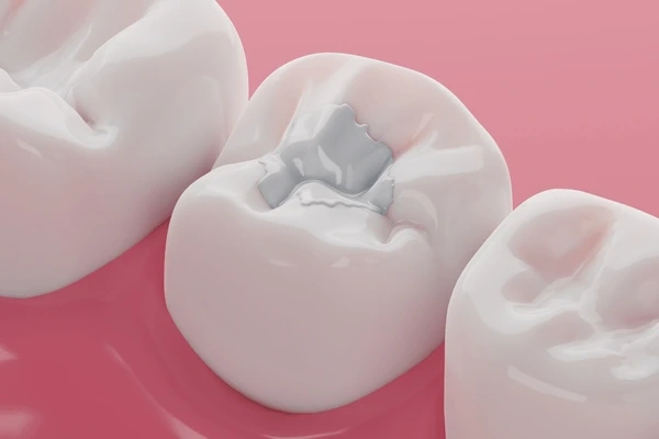 composite fillings near you