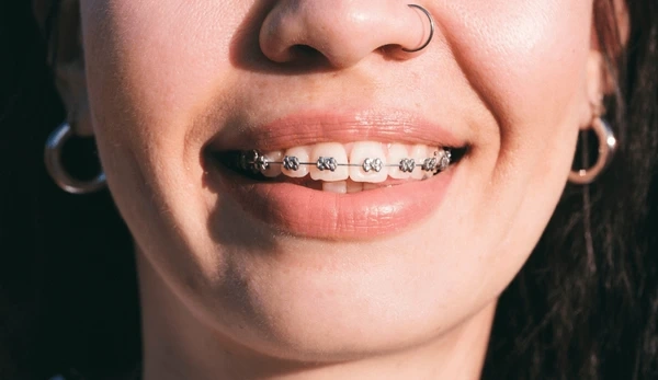 dental braces near you