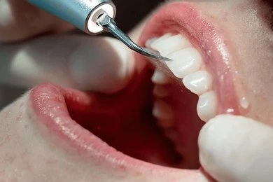 dental cleanings in tisdale, sk