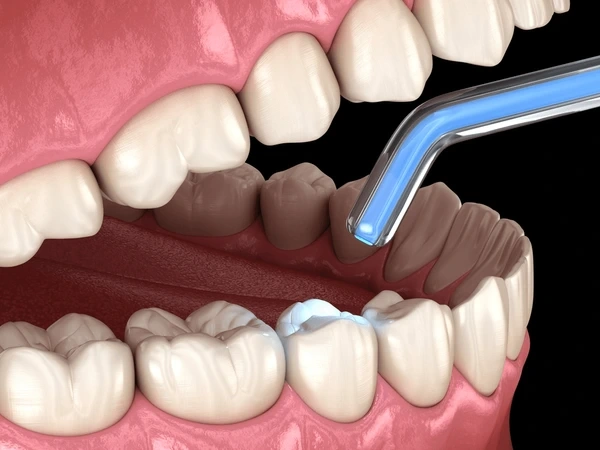 dental fillings near you