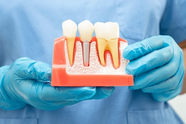 dental implants near you