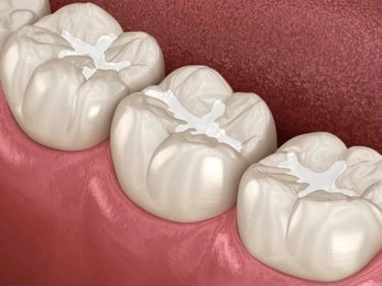 dental sealants near you