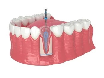 endodontics in tisdale, sk