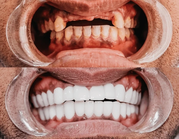 full mouth reconstruction near you