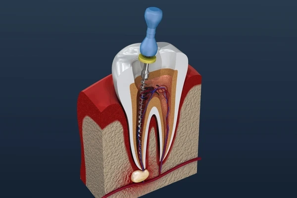 root canal therapy in tisdale, sk