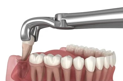 surgical extractions in tisdale, sk